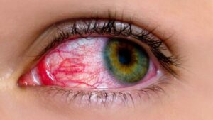 Pink eye disease in pakistan